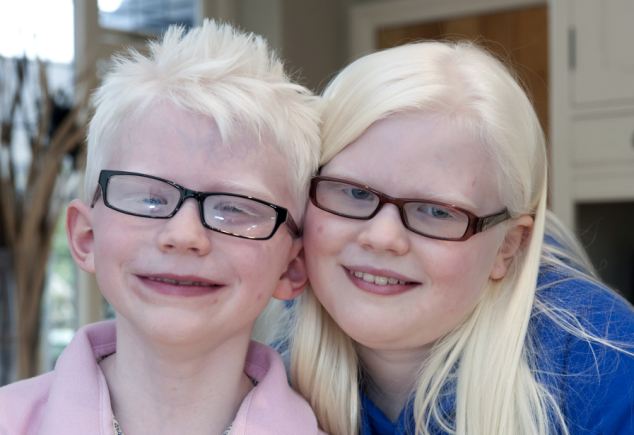 albinisma 7 anomali genetik yang menjadikan manusia unik