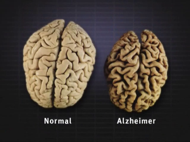 alzheimer pada otak