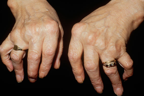 arthritis 8 penyakit kronik yang mampu dirawat oleh ganja