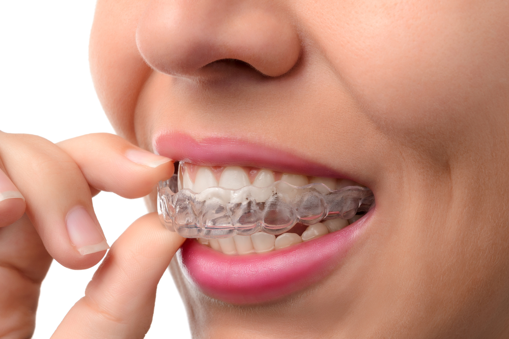 braces retainer pendakap gigi penahan