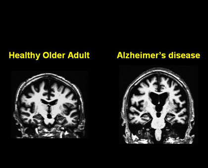 contoh mri pesakit alzheimer dan orang normal