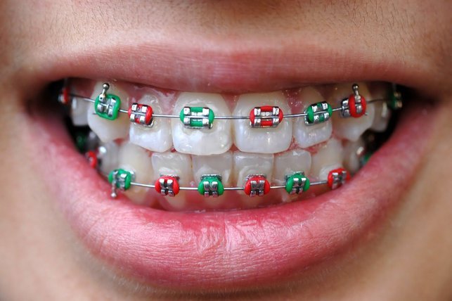 dental braces malaysia