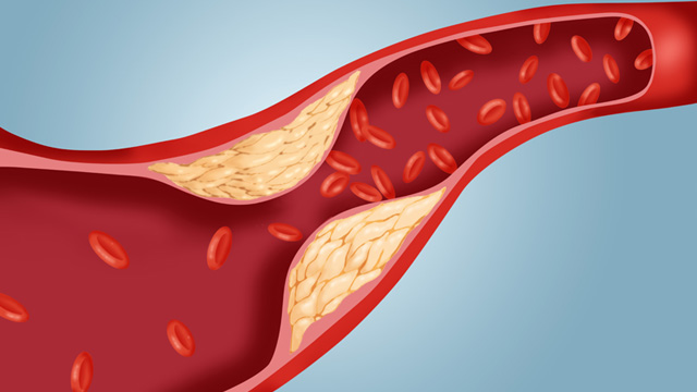 gty atherosclerosis cholesterol plaque artery ll 111114 wmain
