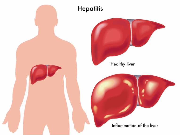 hepatitis b 37059