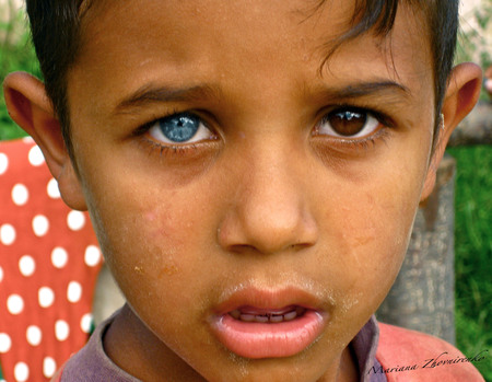 human with heterochromia