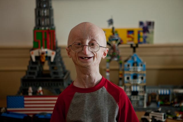hutchinson gilford progeria 2