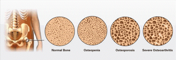 kaki ayam osteoporosis