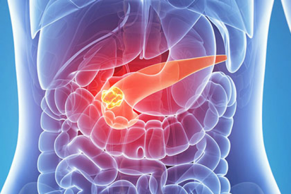 kanser pancreatic