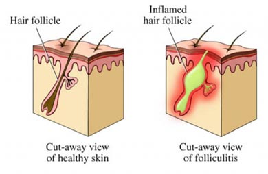 kecederaan pada kulit akibat cukur