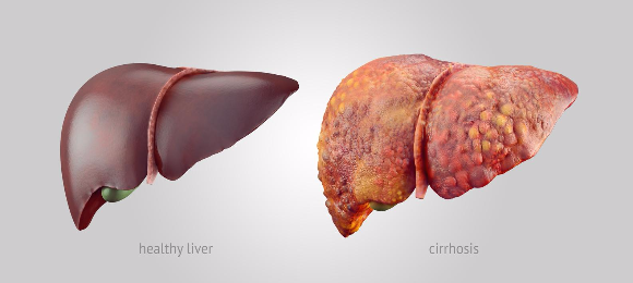 organ hati sihat dan dijangkiti hepatits b