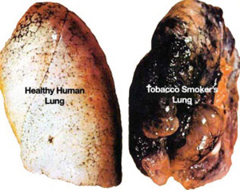 paru paru sihat dan paru paru perokok