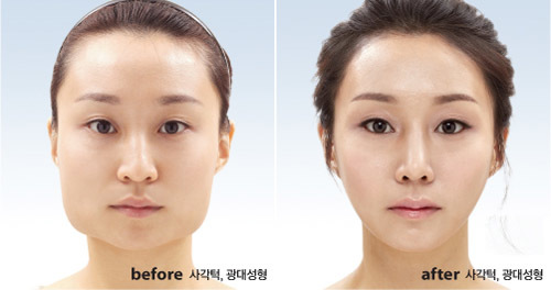 pembedahan kontur muka korea selatan