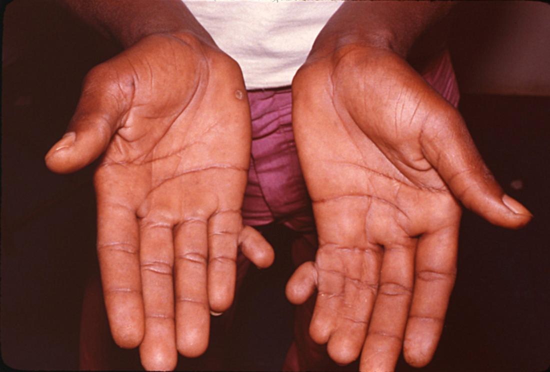 polydactyly