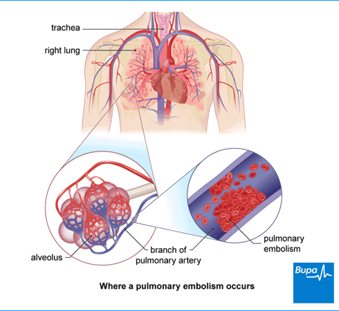 pulmonary embolism pembunuh ibu melayu 3