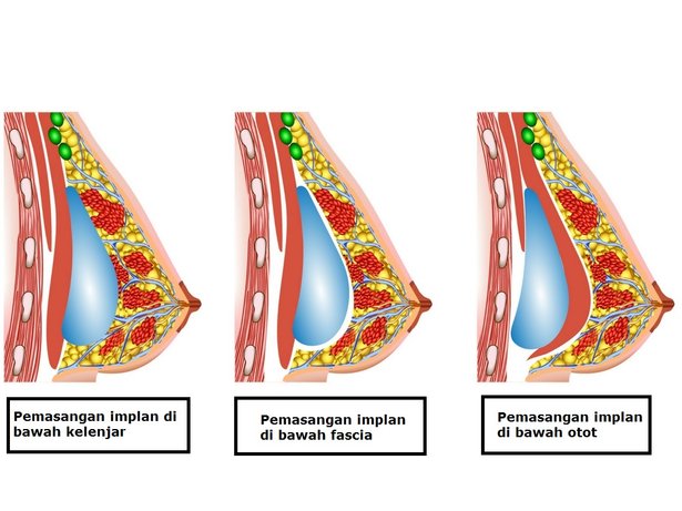 3 jenis pembedahan pembesaran payudara 971