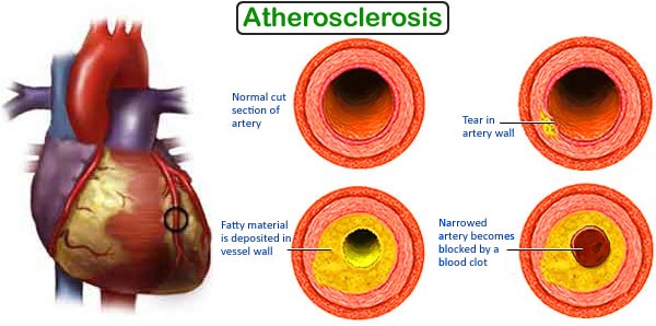 aterosklerosis boleh menyebabkan strok serangan jantung dan boleh menyebabkan anda mati
