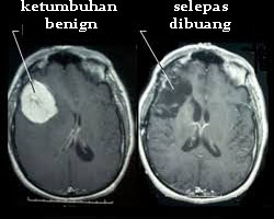 benign meningioma ketumbuhan otak paling kerap berlaku 5