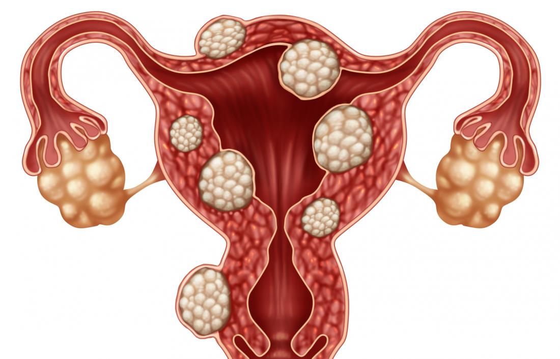 fibroid berlaku kepada 1 dalam setiap 3 wanita