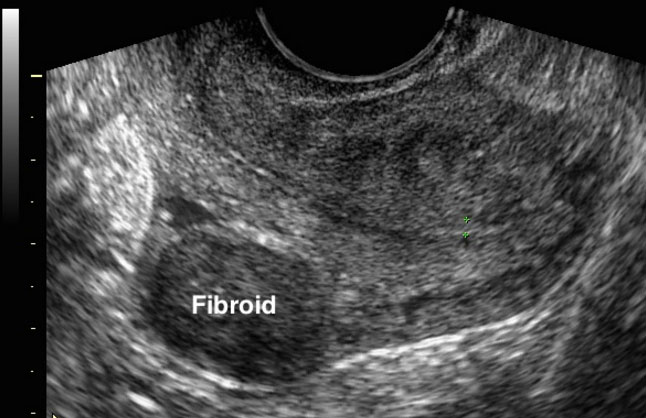 fibroid boleh dikesan melalui imbasan
