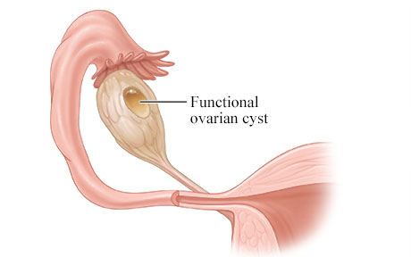 functional cyst diagram 937