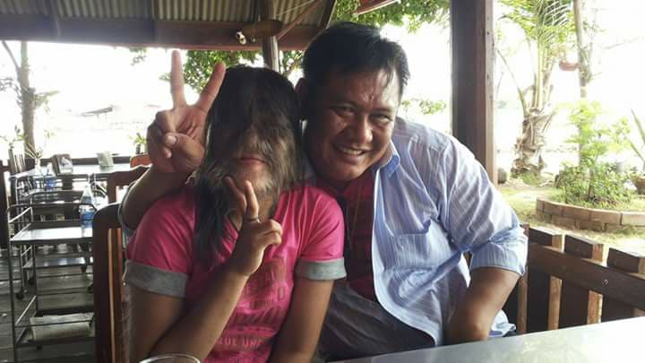 gadis thailand supattra sindrom ambras