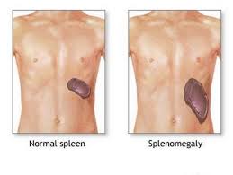 images enlarged spleen