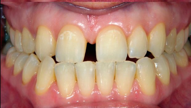 ini 2 jenis rawatan pemutihan gigi 3