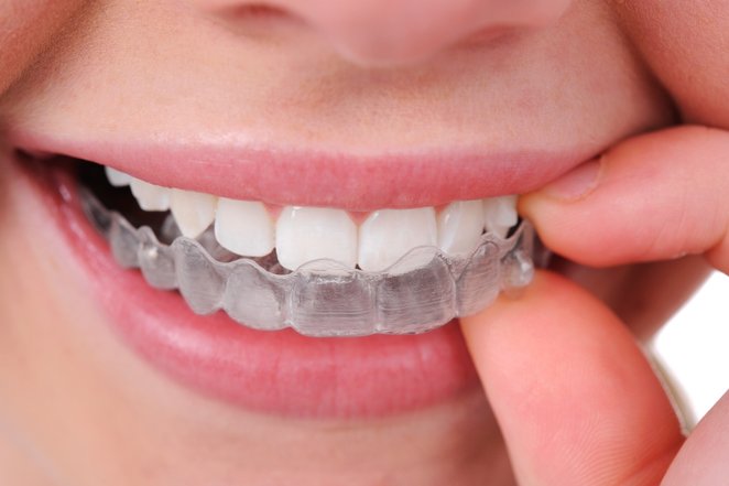 ini 2 jenis rawatan pemutihan gigi 7