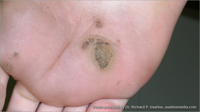 kanser kulit pada tapak kaki