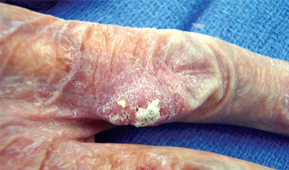 kanser kulit