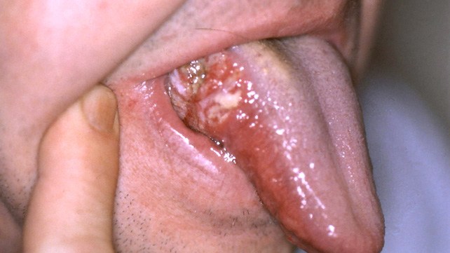 kanser pada lidah