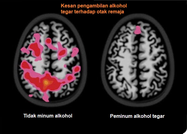 kesan pengambilan alkohol tegar terhadap otak remaja