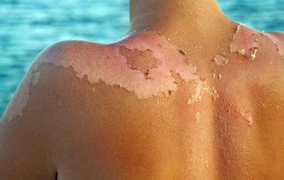kulit sunburn tanpa oksigen
