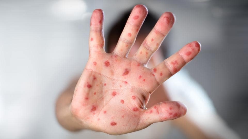 measles 106