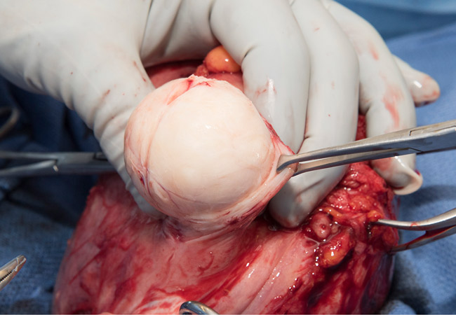 pembedahan mengeluarkan fibroid