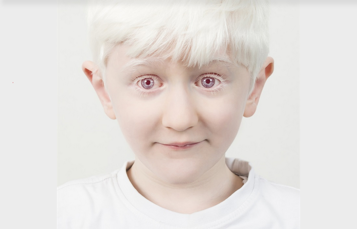 penghidap albino mata merah