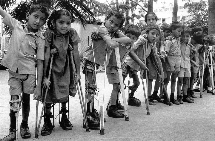 penyakit polio