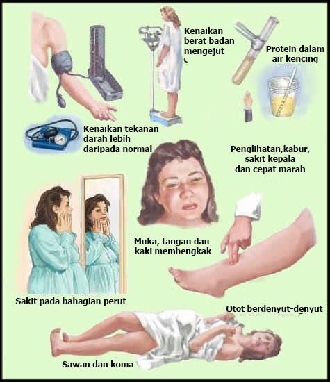 Ubat Tahan Sakit Untuk Bersalin - Contoh Nis