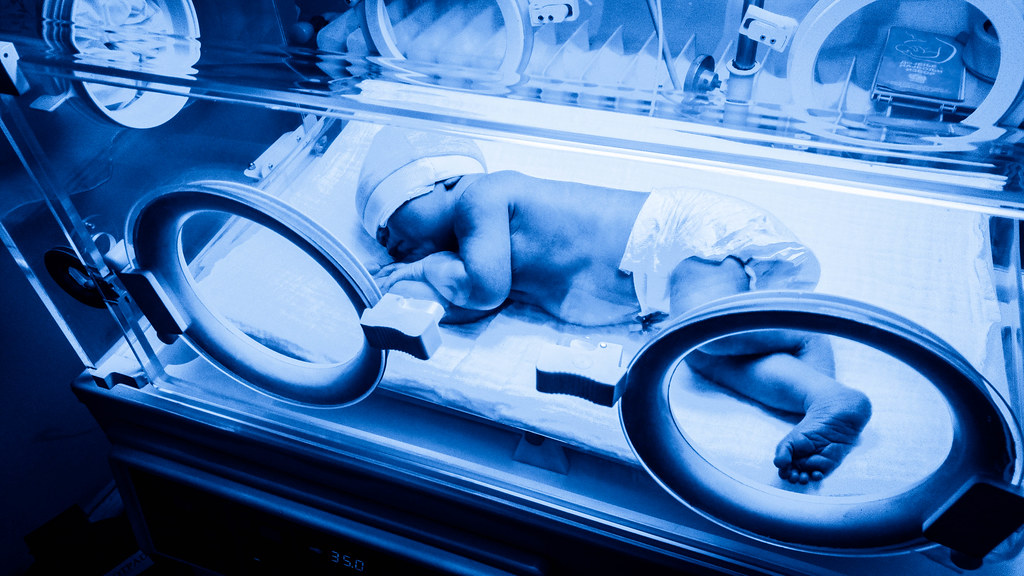 rawatan fototerapi jaundis demam kuning bayi