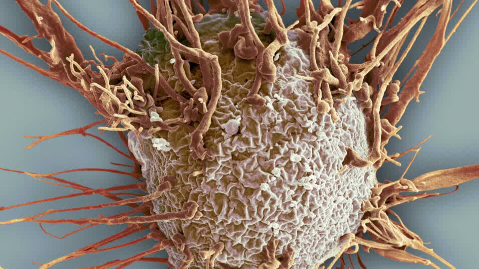 sel kanser bawah mikroskop