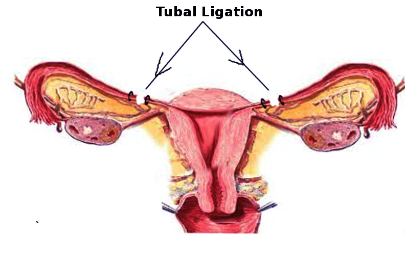 tubal ligation