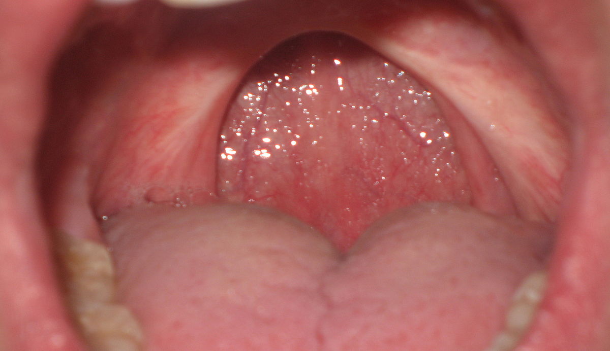 uvulopalatopharyngoplasty tiada uvula