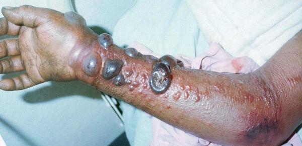 virus marburg 5 penyakit yang mencegah penyakit lain