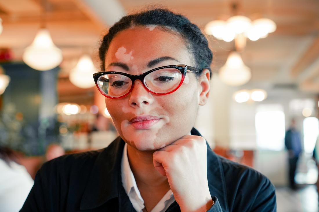 wanita yang mengidap penyakit vitiligo