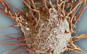 Bagaimana Rupa Sel Kanser Pada Tubuh Yang Dijangkiti?