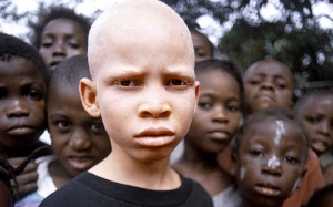 Fakta Menyedihkan Mengenai Nasib Orang Albino di Afrika