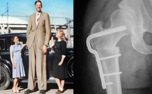 Osteotomi : Pembedahan Yang Mampu Menambah Ketinggian Anda 6 Inci