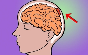 Kenali 5 Tanda Ketumbuhan Otak Yang Paling Kerap Berlaku : Benign Meningioma